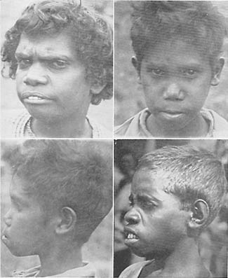 Deformity patterns produced in the modernized Aborigines of Australia by 